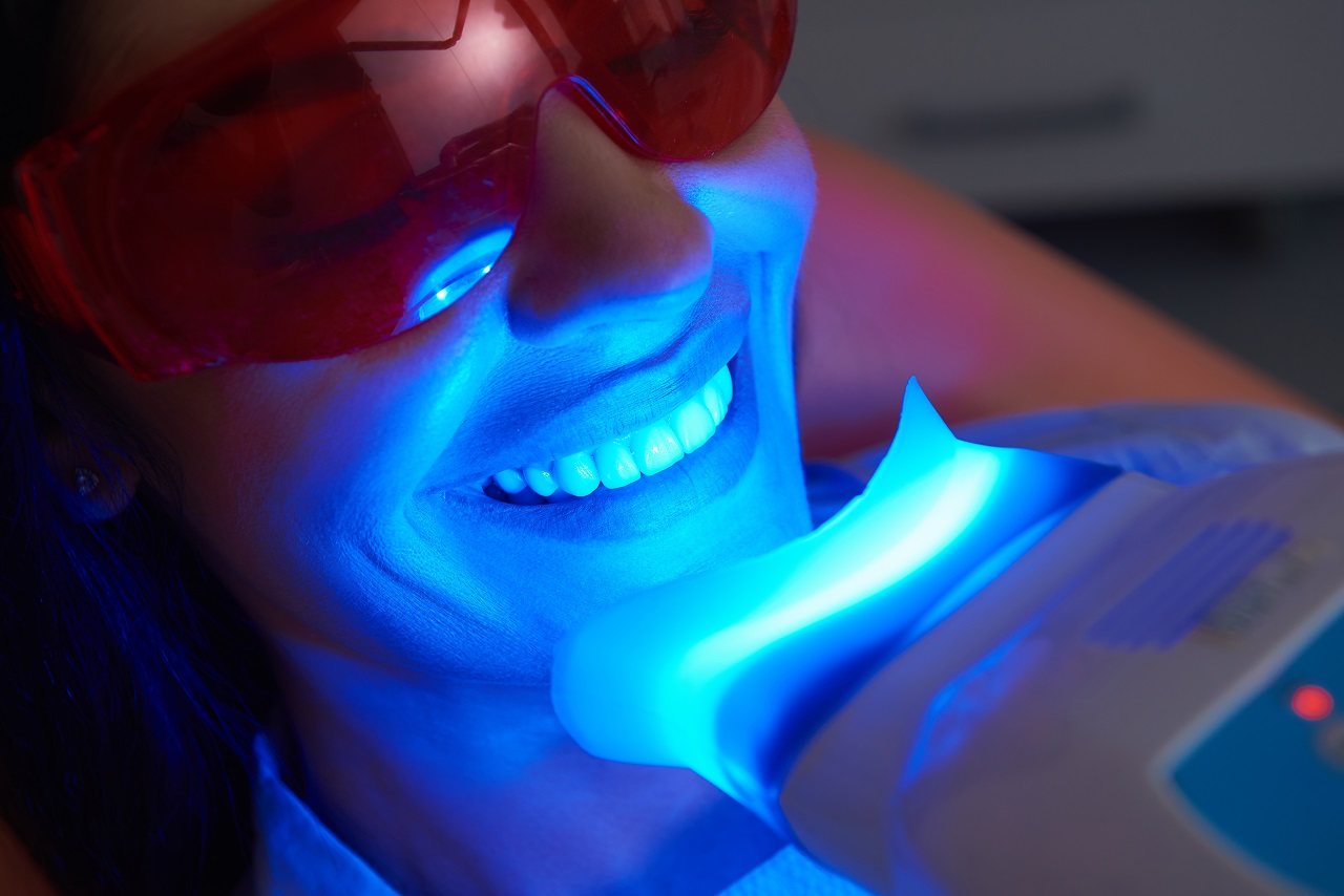 Wybielanie zębów – na jaką metodę się zdecydować?